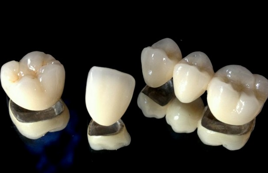 Pfm Crowns And Pfm Bridge