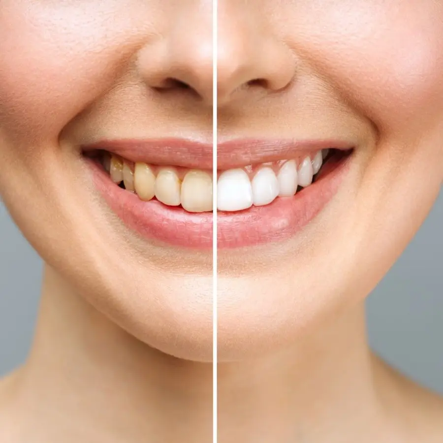 Woman Smiling Showing How To Whiten Teeth