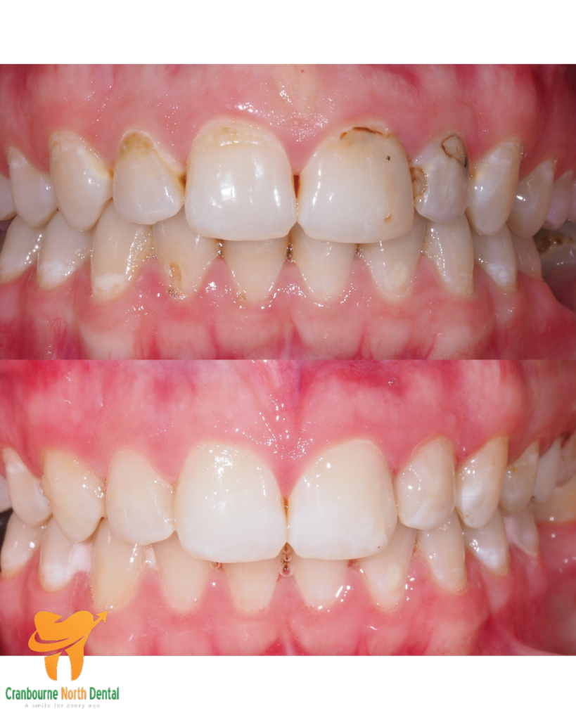 Decay Before/After - Cranbourne North Dental