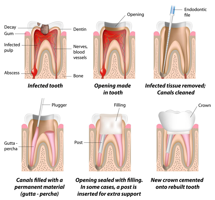 Root Canal Treatment Illustration Bd1a10