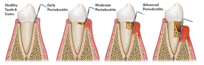 Advanced Gum Disease Progression