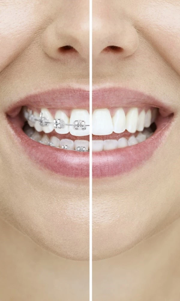 Clear Aligners Vs Braces