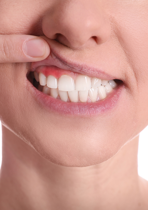 Woman Showing Inflamed Gums On White Background, Closeup View 1445401314 6720x4480