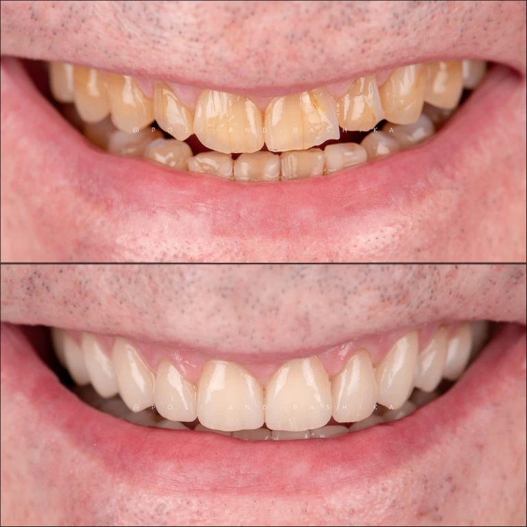 Before And After Enamel Erosion Dental Crowns Medium