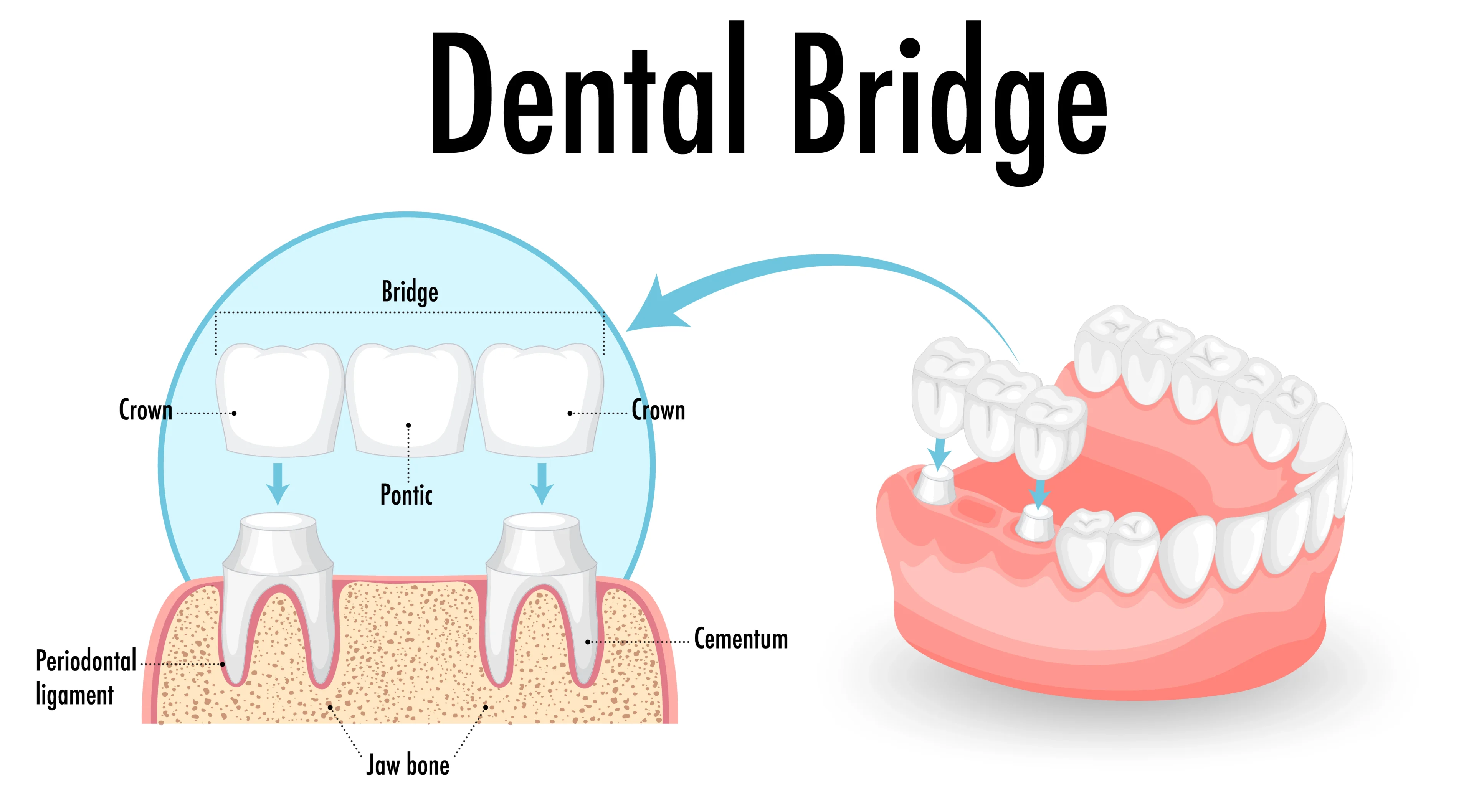 Dental Bridge Diagram