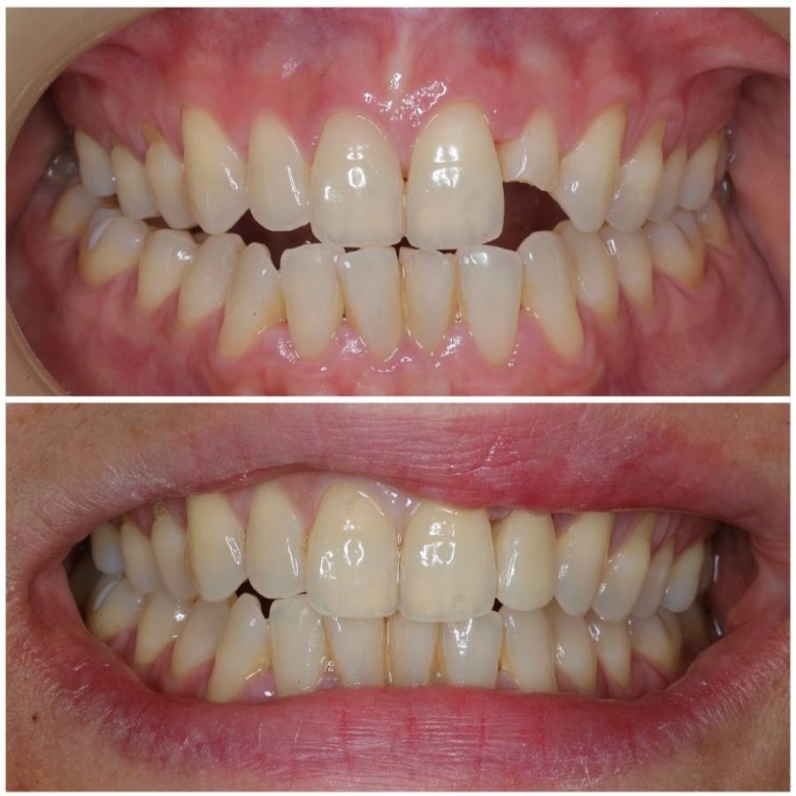 Htd Before After 22 Ceramic Veneer