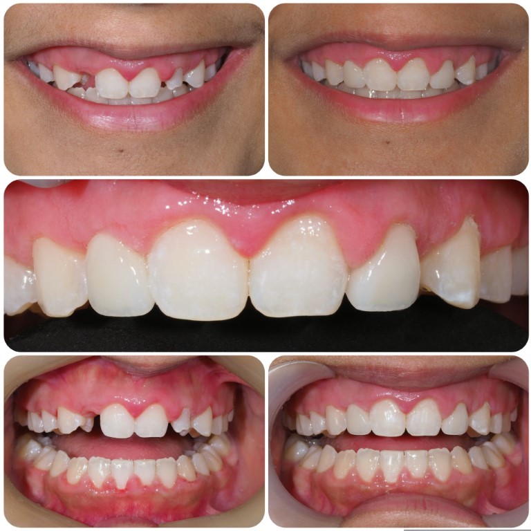 Before After Maryland Bridge And Veneers