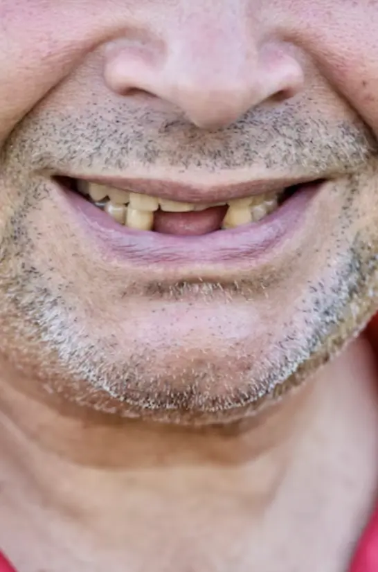 Man In Red Missing Lower Teeth Profile